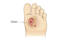 Diabetic Foot Ulcer Management