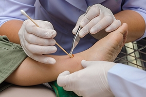 The Importance of Treating Foot Wounds