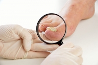 Causes and Treatments for Toenail Infections