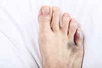 Recognizing the Signs and Finding Relief for a Broken Toe