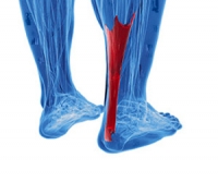 Two Types of Achilles Tendonitis